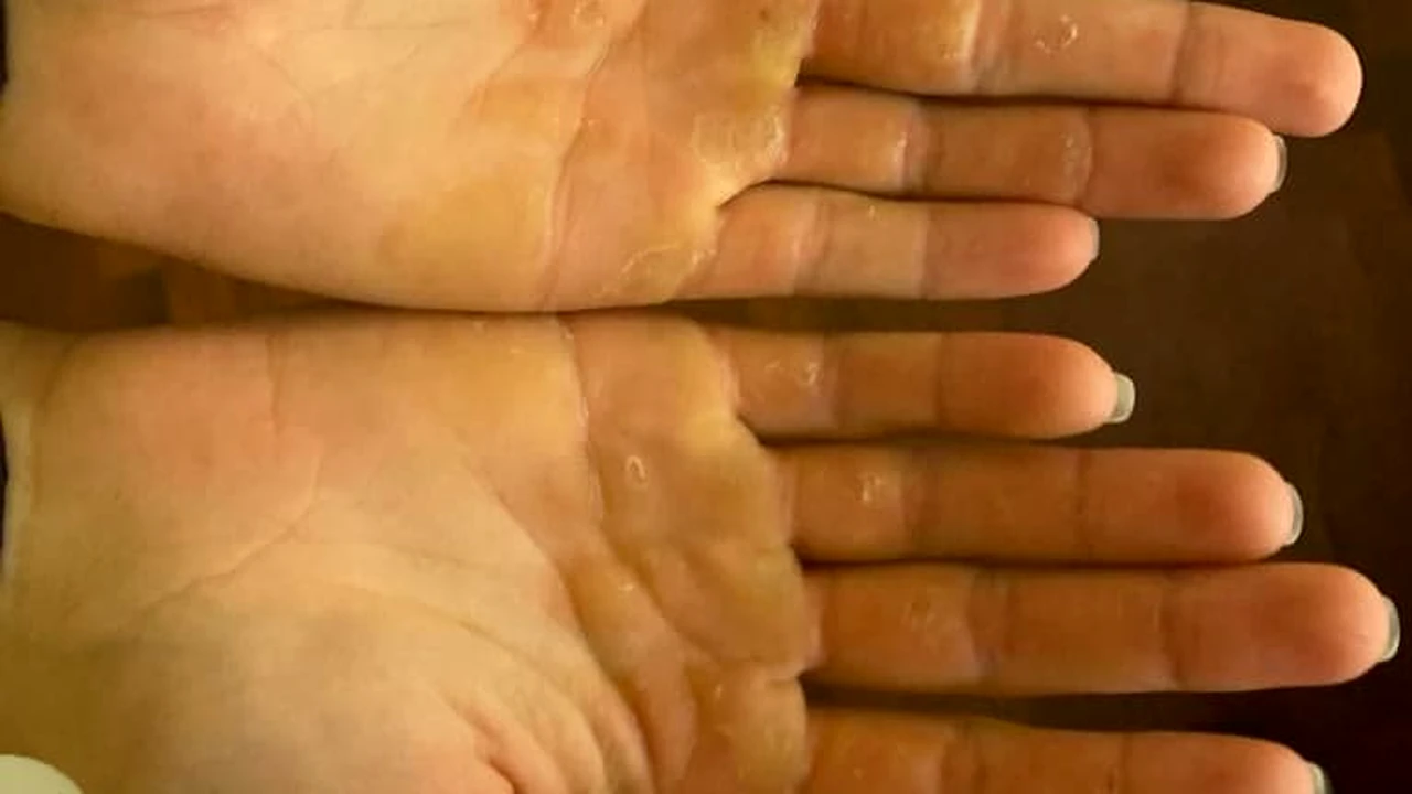 EXCLUSIV. Suferințele unei campioane povestite de Simona Radiș: „A fost dureros când rănile din palme erau deschise!”