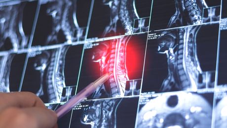 Dureri de spate? CT-ul coloanei la MedLife îți arată cauza reală