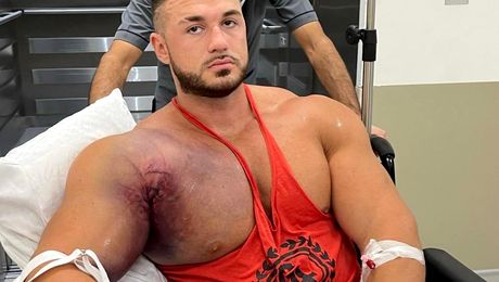 Imagini halucinante, cu sportivul căruia i-a ”explodat” mușchiul la antrenamente! ”Tot corpul meu era umflat!”